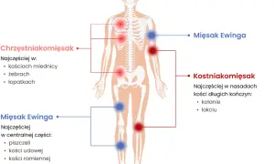 Schemat pokazuje lokalizację mięsaków: mięsak Ewinga w centralnej części ciała (piszczel, kość udowa, ramienna), a kostniakomięsak w nasadach kości długich.