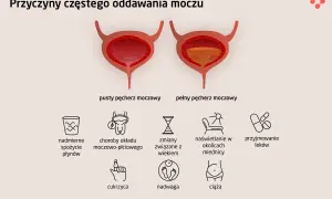 Ilustracja przedstawia przyczyny częstego oddawania moczu: nadmierne picie, choroby układu moczowo-płciowego, wiek, naświetlanie miednicy, leki, cukrzyca, nadwaga, ciąża.