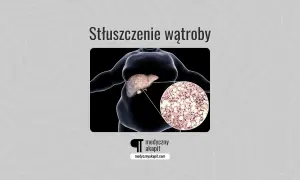 Stłuszczenie wątroby: obraz przedstawia sylwetkę osoby z widoczną wątrobą i powiększony fragment tkanki wątrobowej z komórkami tłuszczowymi.