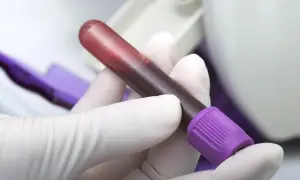 Ręka w białej rękawiczce trzyma probówkę z krwią, która może być badana pod kątem hipofibrynogemii.