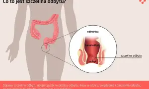 Ilustracja przedstawia anatomię odbytu z zaznaczoną szczeliną. Objawy szczeliny odbytu to ból, krwawienie i pieczenie.