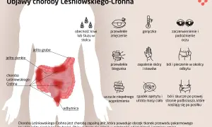 Objawy choroby Leśniowskiego-Crohna: ból brzucha, biegunka, zmęczenie, gorączka, problemy ze skórą i oczami.