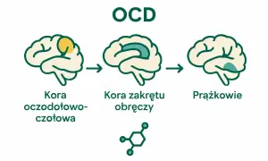 Schemat mózgu ilustrujący zaburzenia obsesyjno-kompulsyjne (OCD). Pokazuje zmiany w korze oczodołowo-czołowej, korze zakrętu obręczy i jądrach podstawy.