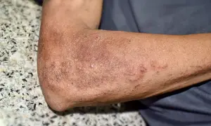 Skóra na ramieniu z wysypką, zaczerwienieniem i strupkami.