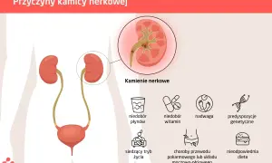Ilustracja przedstawia przyczyny kamicy nerkowej: niedobór płynów, witamin, siedzący tryb życia, nadwagę, choroby układu pokarmowego i moczowo-płciowego, nieodpowiednią dietę oraz predyspozycje genetyczne.