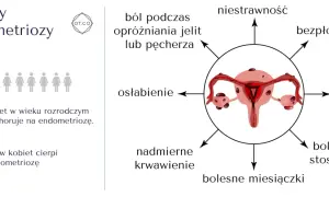 Objawy endometriozy: ból, osłabienie, nadmierne krwawienie, niestrawność, bezpłodność, mdłości, bolesny stosunek, bolesne miesiączki. 1 na 10 kobiet choruje.