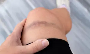 Siniak na kolanie, objaw problemów z krzepnięciem krwi, jak w przypadku hemofilii. Dłoń dotyka bolącego miejsca.