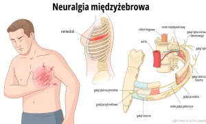 Ilustracja pokazuje mężczyznę z bólem w klatce piersiowej, symbolizującym **neuralgię międzyżebrową**. Widoczne są żebra, kręgosłup i nerwy.