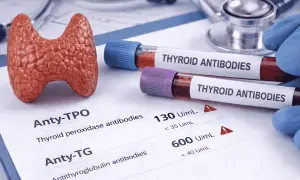 Model tarczycy, probówki z napisem "THYROID ANTIBODIES" i wyniki badań, wskazujące na podwyższone atg.