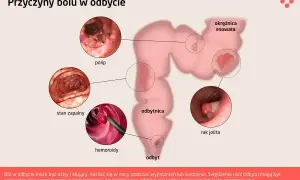 Ilustracja przedstawia przyczyny bólu w odbycie: polip, stan zapalny, hemoroidy, okrężnicę esowatą i raka jelita. Objaw Blumberga może towarzyszyć tym schorzeniom.