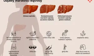 Objawy marskości wątroby: ból brzucha, zmęczenie, utrata masy ciała, żółtaczka, obrzęki, gorączka, swędzenie skóry.