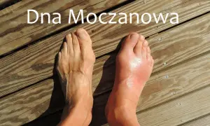 Dwa stopy na drewnianym tarasie. Prawy stopa jest zaczerwieniona i opuchnięta, co sugeruje atak podagry.