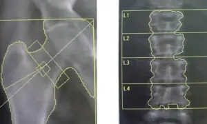 Wyniki badania densytometria: obraz RTG stawu biodrowego i kręgosłupa lędźwiowego z zaznaczonymi obszarami pomiaru.