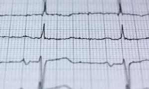 Nieregularne linie EKG na papierze milimetrowym, wskazujące na migotanie przedsionków.