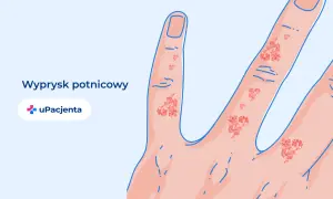 Ilustracja przedstawia dłoń z widocznym wypryskiem potnicowym na palcach.