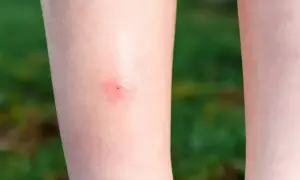 Czerwona, swędząca plamka na nodze po meszka ugryzieniu.