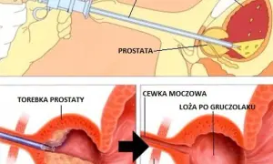 Czy pacjent ma prawo do sanatorium po operacji prostaty? Sprawdź warunki