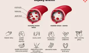 Niedobór żelaza - anemia objawia się bladością skóry, spadkiem energii, szumami usznymi, zmęczeniem, bólami głowy i innymi symptomami.