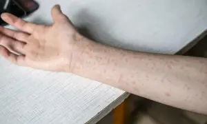 Ręka pokryta drobnymi, czerwonymi plamkami, które mogą być objawem odry.