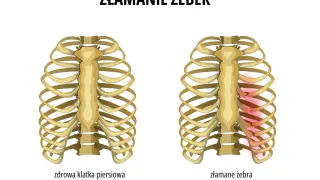 Porównanie zdrowej klatki piersiowej z klatką ze złamanymi żebrami, gdzie uszkodzone żebra są zaznaczone na czerwono.