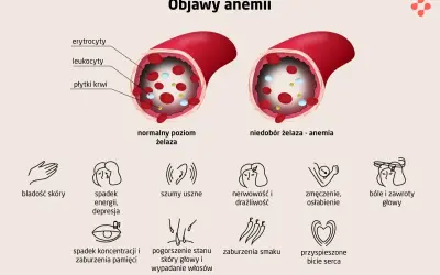 Niedobór żelaza - anemia objawia się bladością skóry, spadkiem energii, szumami usznymi, zmęczeniem, bólami głowy i innymi symptomami.