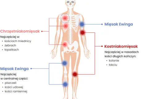 Schemat pokazuje lokalizację mięsaków: mięsak Ewinga w centralnej części ciała (piszczel, kość udowa, ramienna), a kostniakomięsak w nasadach kości długich.