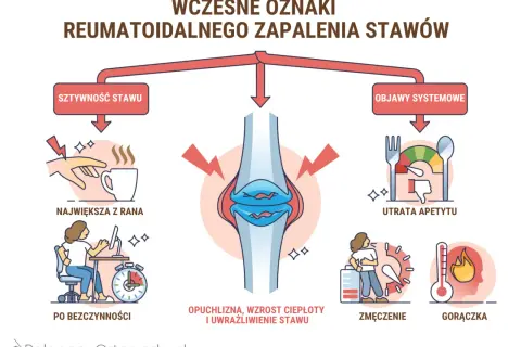 Ilustracja pokazuje wczesne objawy reumatoidalnego zapalenia stawów: sztywność stawów, utratę apetytu, zmęczenie i gorączkę.
