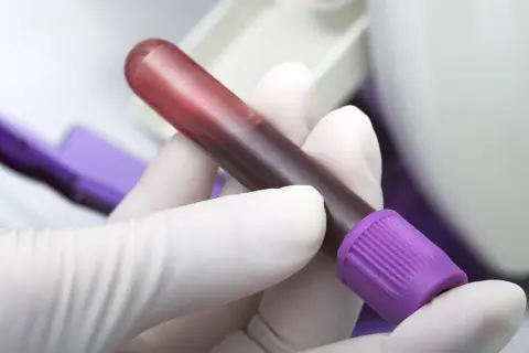 Ręka w białej rękawiczce trzyma probówkę z krwią, która może być badana pod kątem hipofibrynogemii.