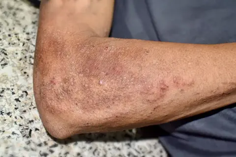 Skóra na ramieniu z wysypką, zaczerwienieniem i strupkami.