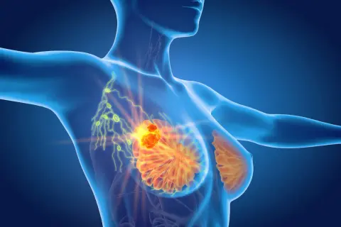 Anatomia piersi z widocznym guzem i węzłami chłonnymi. Ból pod pachą może być objawem.