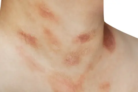 Skóra na szyi i klatce piersiowej z czerwonymi, łuszczącymi się plamami, które mogą być objawem łupieżu Gilberta.