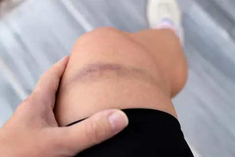 Siniak na kolanie, objaw problemów z krzepnięciem krwi, jak w przypadku hemofilii. Dłoń dotyka bolącego miejsca.