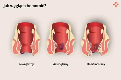Ilustracja pokazuje trzy rodzaje hemoroidów: zewnętrzne, wewnętrzne i kombinowane. Nie są to zdjęcia raka odbytu.