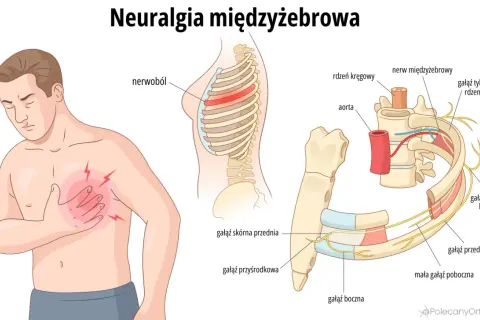 Ilustracja pokazuje mężczyznę z bólem w klatce piersiowej, symbolizującym **neuralgię międzyżebrową**. Widoczne są żebra, kręgosłup i nerwy.