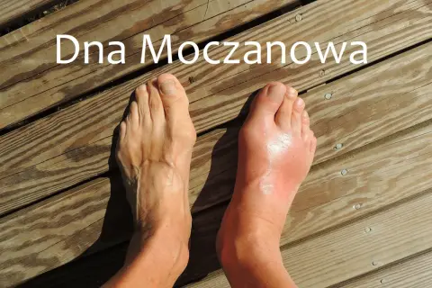 Dwa stopy na drewnianym tarasie. Prawy stopa jest zaczerwieniona i opuchnięta, co sugeruje atak podagry.