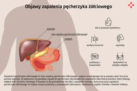 Anatomia człowieka z zaznaczonym pęcherzykiem żółciowym, wątrobą i żołądkiem. Obok objawy zapalenia pęcherzyka żółciowego.