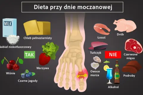 Dieta przy dnie moczanowej: TAK - nabiał niskotłuszczowy, chleb pełnoziarnisty, warzywa, wiśnie, czarne jagody. NIE - drób, łosoś, tuńczyk, czerwone mięso, owoce morza, alkohol, podroby. Jak obniżyć kwas moczowy?