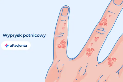 Ilustracja przedstawia dłoń z widocznym wypryskiem potnicowym na palcach.