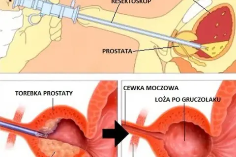 Czy pacjent ma prawo do sanatorium po operacji prostaty? Sprawdź warunki