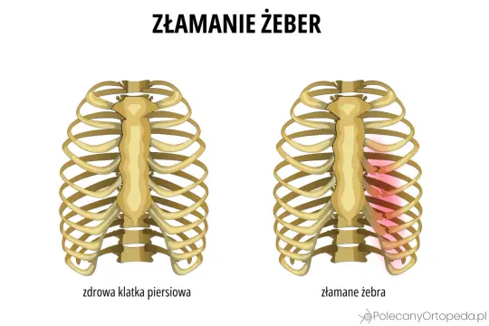 Porównanie zdrowej klatki piersiowej z klatką ze złamanymi żebrami, gdzie uszkodzone żebra są zaznaczone na czerwono.