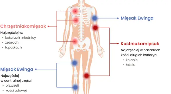 Schemat pokazuje lokalizację mięsaków: mięsak Ewinga w centralnej części ciała (piszczel, kość udowa, ramienna), a kostniakomięsak w nasadach kości długich.