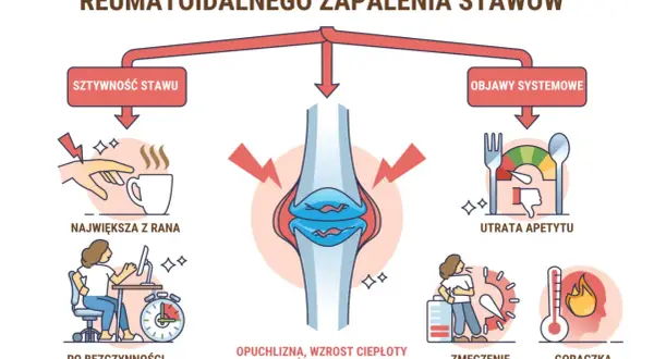 Ilustracja pokazuje wczesne objawy reumatoidalnego zapalenia stawów: sztywność stawów, utratę apetytu, zmęczenie i gorączkę.