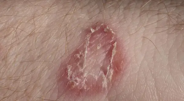 Zmiany skórne z łuszczącym się naskórkiem, zaczerwienieniem i włoskami, mogą sugerować infekcję grzybiczą, np. candida.