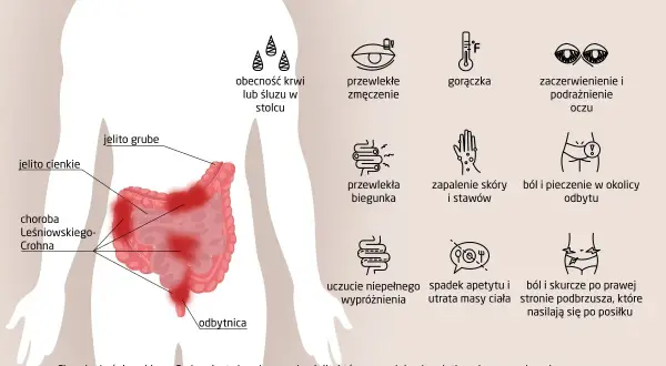 Objawy choroby Leśniowskiego-Crohna: ból brzucha, biegunka, zmęczenie, gorączka, problemy ze skórą i oczami.