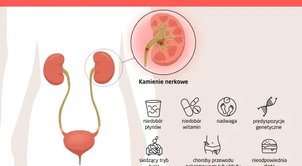 Ilustracja przedstawia przyczyny kamicy nerkowej: niedobór płynów, witamin, siedzący tryb życia, nadwagę, choroby układu pokarmowego i moczowo-płciowego, nieodpowiednią dietę oraz predyspozycje genetyczne.