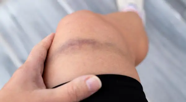 Siniak na kolanie, objaw problemów z krzepnięciem krwi, jak w przypadku hemofilii. Dłoń dotyka bolącego miejsca.
