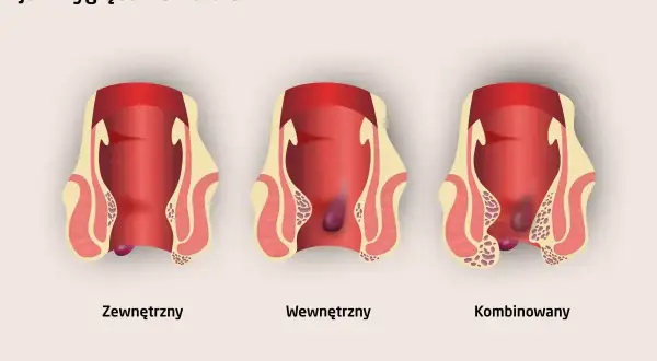 Ilustracja pokazuje trzy rodzaje hemoroidów: zewnętrzne, wewnętrzne i kombinowane. Nie są to zdjęcia raka odbytu.