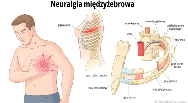 Ilustracja pokazuje mężczyznę z bólem w klatce piersiowej, symbolizującym **neuralgię międzyżebrową**. Widoczne są żebra, kręgosłup i nerwy.