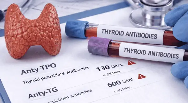 Model tarczycy, probówki z napisem "THYROID ANTIBODIES" i wyniki badań, wskazujące na podwyższone atg.