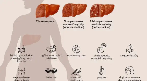 Objawy marskości wątroby: ból brzucha, zmęczenie, utrata masy ciała, żółtaczka, obrzęki, gorączka, swędzenie skóry.